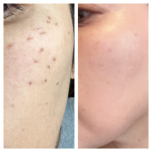 宮崎市でシミケアするなら！OPALEで！